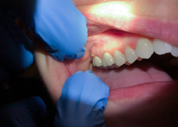 Best Dental Abscess Treatment in Covington, KY